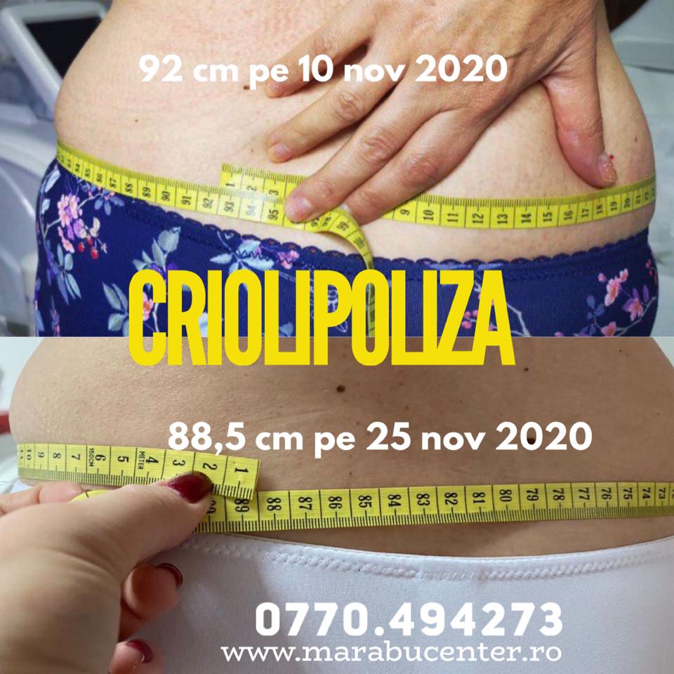 Marabucenter_criolipoliza