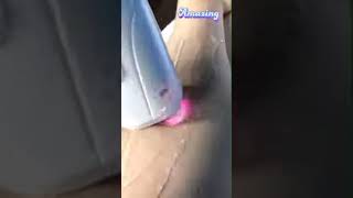 epilare_laser Epilare laser