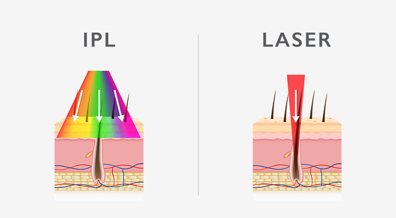Laser vs IPL