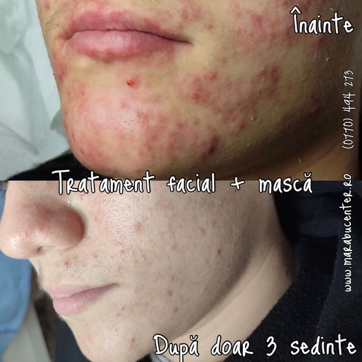 Tratament facial anti-accneic si masca