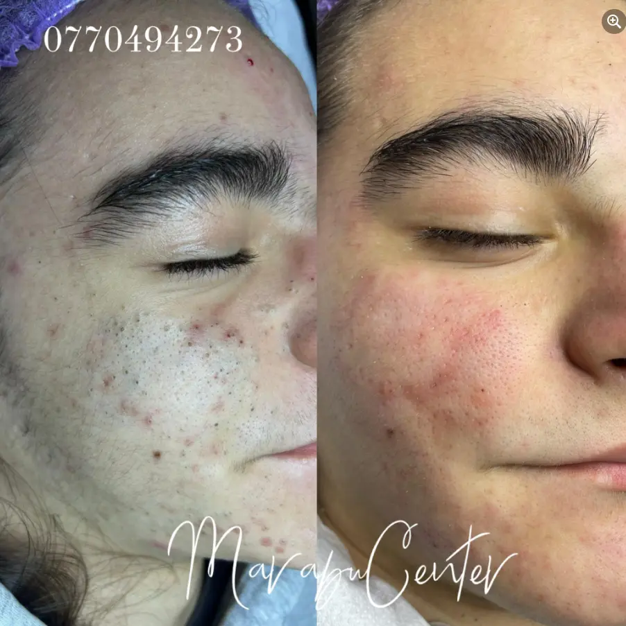 Marabucenter_Bacau_tratament_facial_puncte_negre Marabucenter_Bacau_tratament_facial_puncte_negre