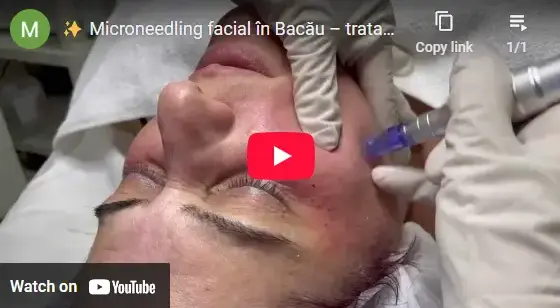 Epilare laser progresiv definitiva-Marabucenter Bacau_Aprilie_2025 Epilare laser progresiv definitiva-Marabucenter Bacau_Aprilie_2025