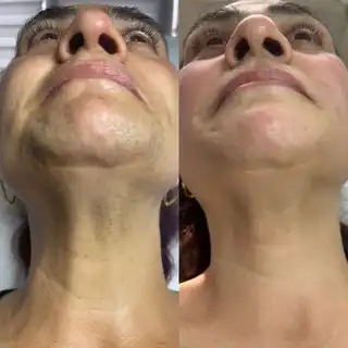 Marabucenter_Bacau_epilare_definitiva_laser_barbie_copy