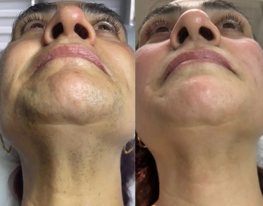 rezultate epilare definitiva laser bacau