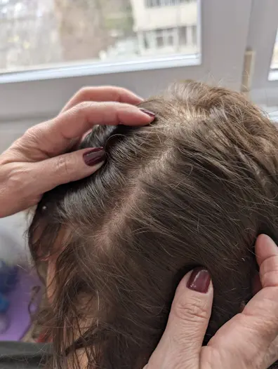 Hairlopecia - rezultate exceptionale - MarabuCenter Bacau