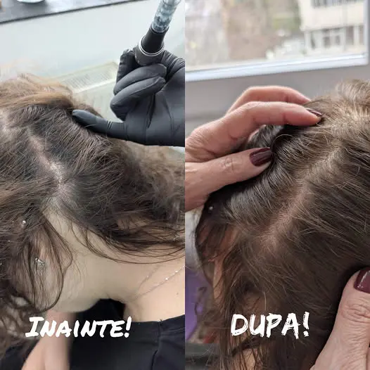 pret tratament caderea parului Bacau – rezultate înainte și după cu exozomi și Hairlopecia la MarabuCenter