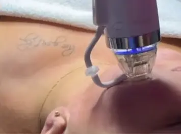 Radiofrecvență fracționată cu microneedling în Bacău la MarabuCenter