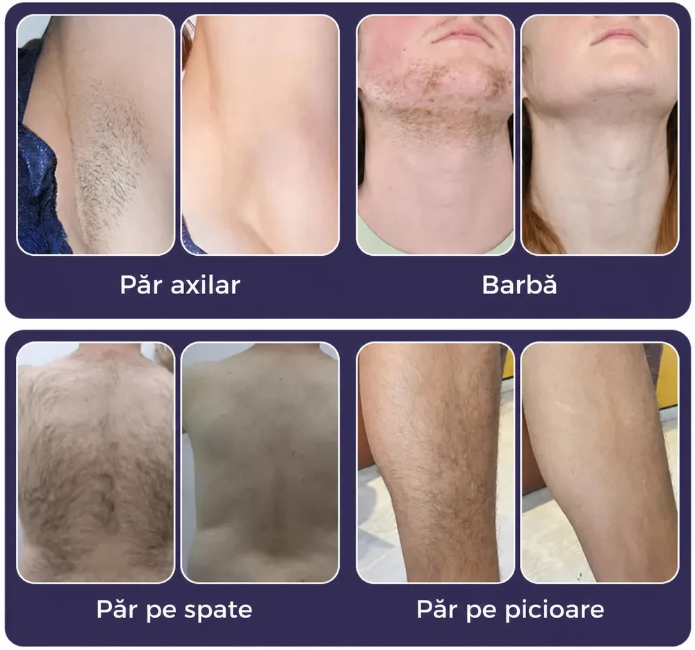 Exemple vizuale de reducere a firelor de păr după epilare definitivă laser