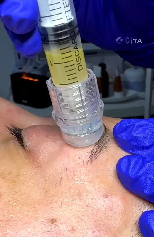 Tratament facial cu exozomi - Marabu Center Bacău Tratament facial cu exozomi realizat la Marabu Center Bacău