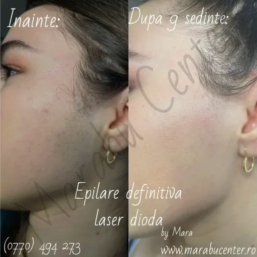 Comparație înainte și după 9 ședințe de epilare laser facială în zona perciunilor, la Marabu Center Bacău.